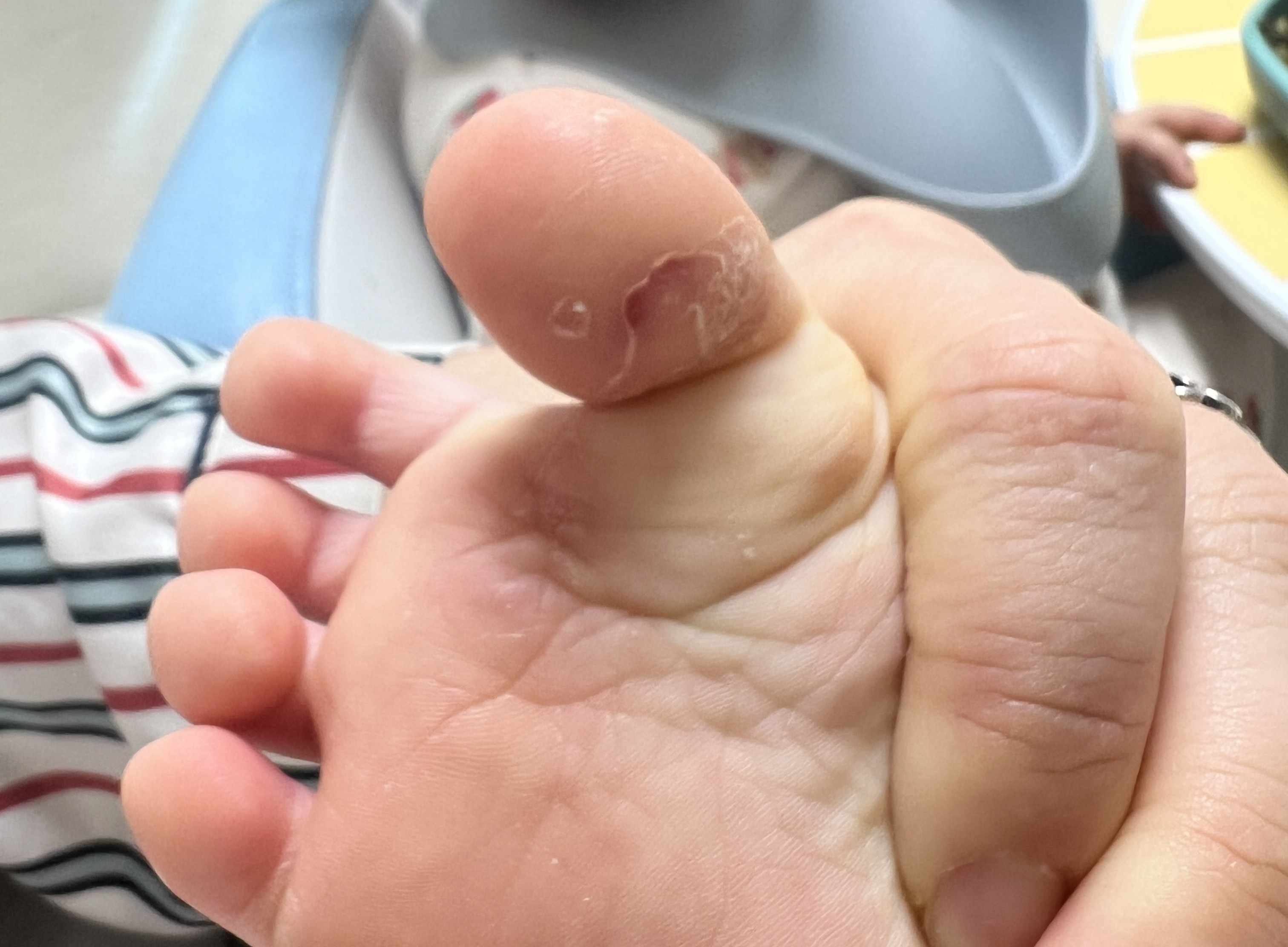 아이 발바닥 발진과 습진