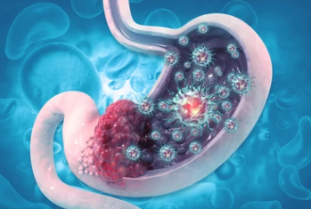 위암 3기 생존율