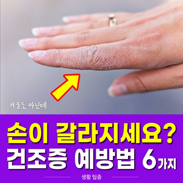 손이 갈라지고 벗겨져요 피부 건조증 예방 치료법, 팁줌