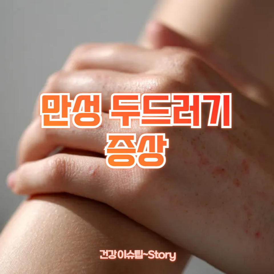 만성 두드러기 증상