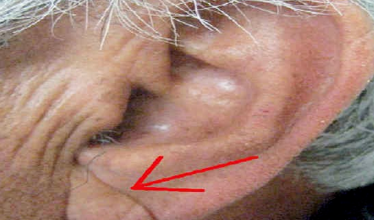 뇌졸중 전조증상