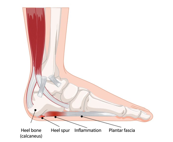 족저근막염 발바닥 아치 구조 설명