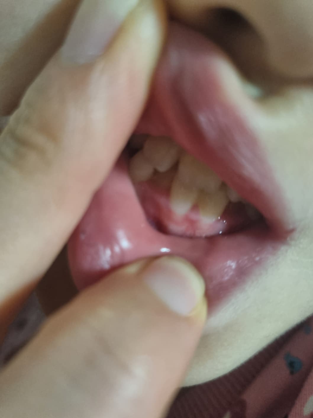 “꼭 해야 하나요?” 어린이 치아교정, 이렇게 관리해요