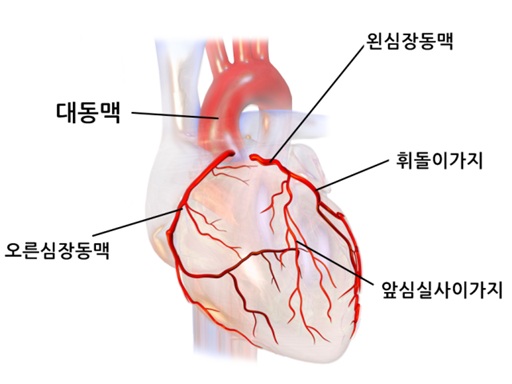 심근경색