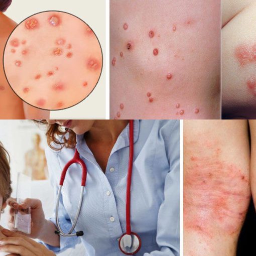 대상포진 예방접종 가격 (+ 최저가&amp;#44; 무료접종)