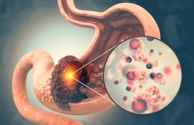위암 초기평소증상