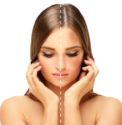 기미 없애는 방법