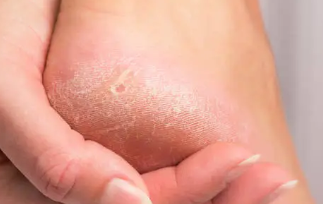 신장이 안좋으면 나타나는 증상 4