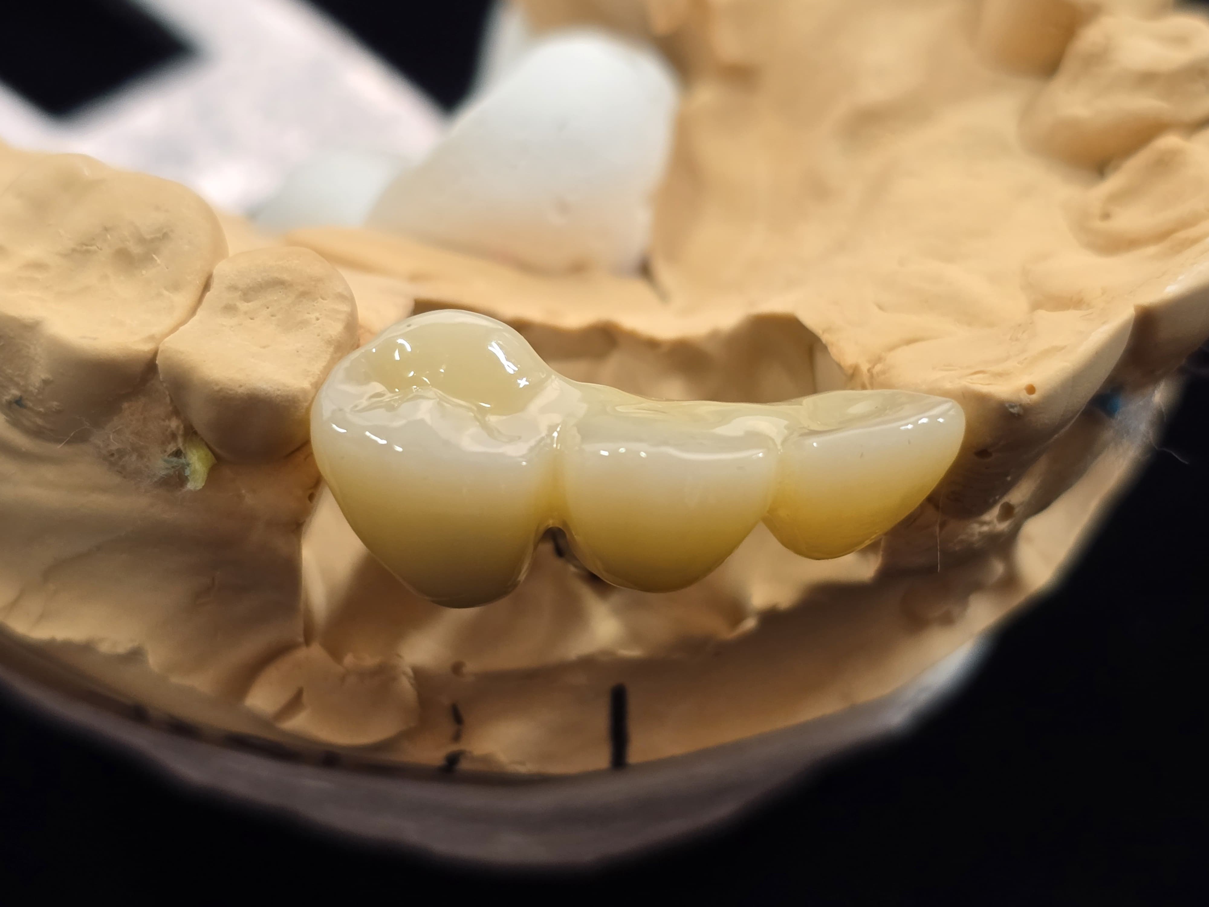 임플란트 vs 브릿지 vs 틀니, 뭘로 할까? 치과 기공사가 뜯어본 '내구성'과 '현실'