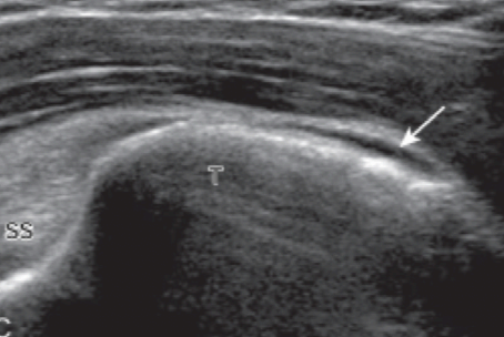 subacromial -subdeltoid bursa