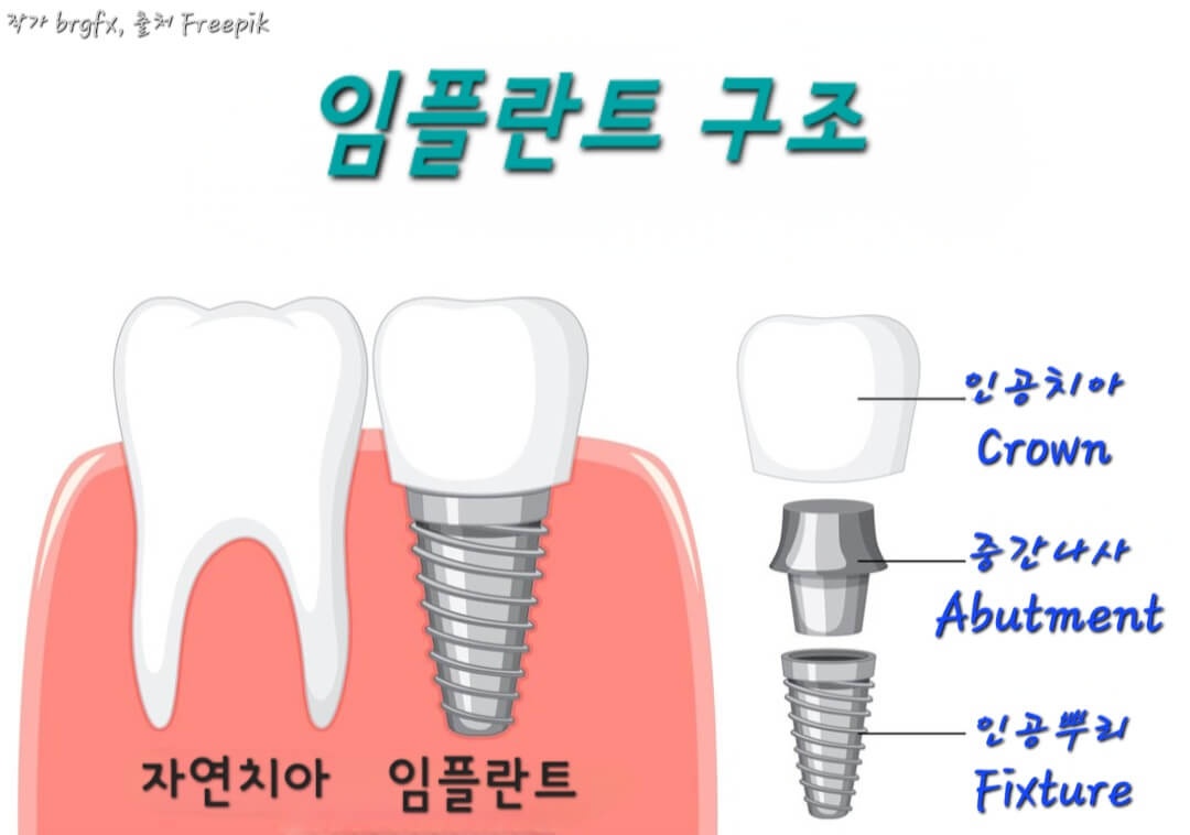 임플라트 구조 사진
