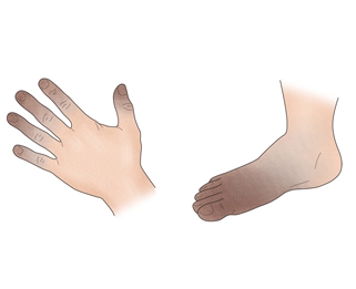 수족냉증에 좋은 음식