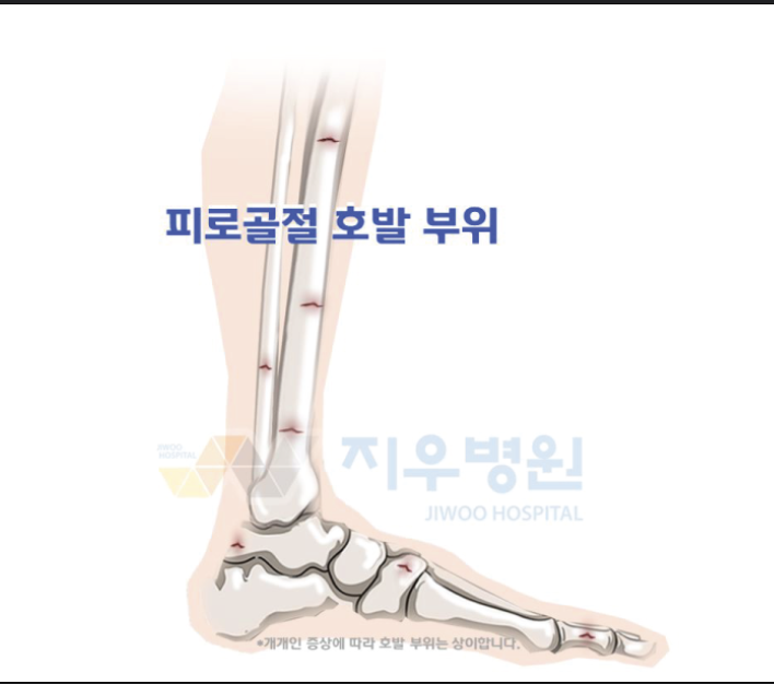 피로골절(3)