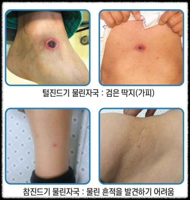 가을철 진드기 감염병 주의보: 예방 방법과 대처 요령