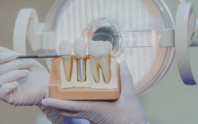 임플란트 가격 확인 최저가 확인 시술기간 (최신)