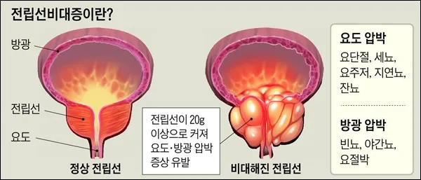 전립선비대증 치료