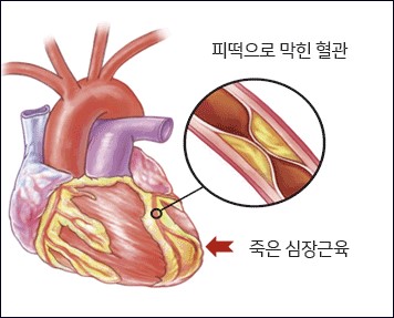 막힌 관상동맥으로 생긴 죽은 심장근육 그림