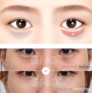 눈밑지방 제거수술 병원 추천 TOP3 / 눈밑지방 제거수술 효과&회복시간 / 부작용&후유증