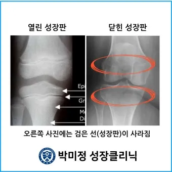 성장판 닫혀도 키 클 수 있는 방법과 성장 호르몬 시기_20