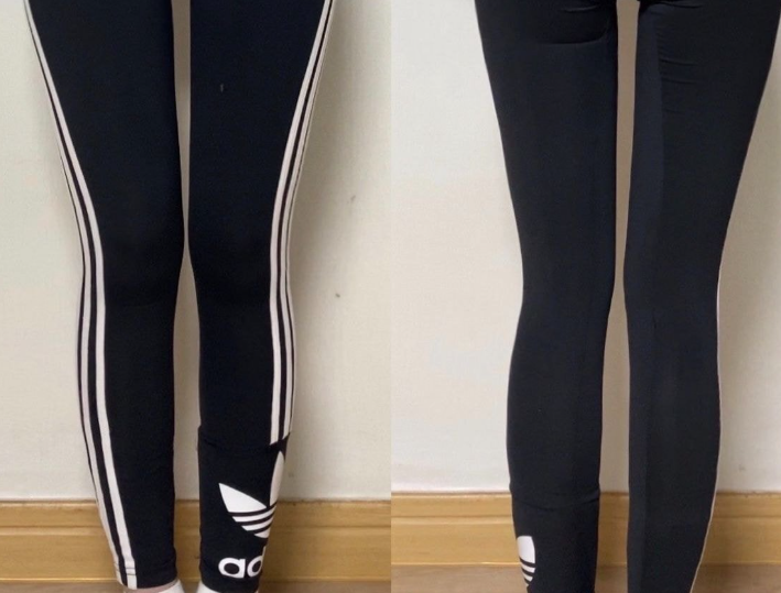 허벅지 지방흡입 후기