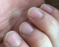 손톱이 잘 부러지는 이유