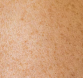 두드러기 치료방법 진단 기준 합병증