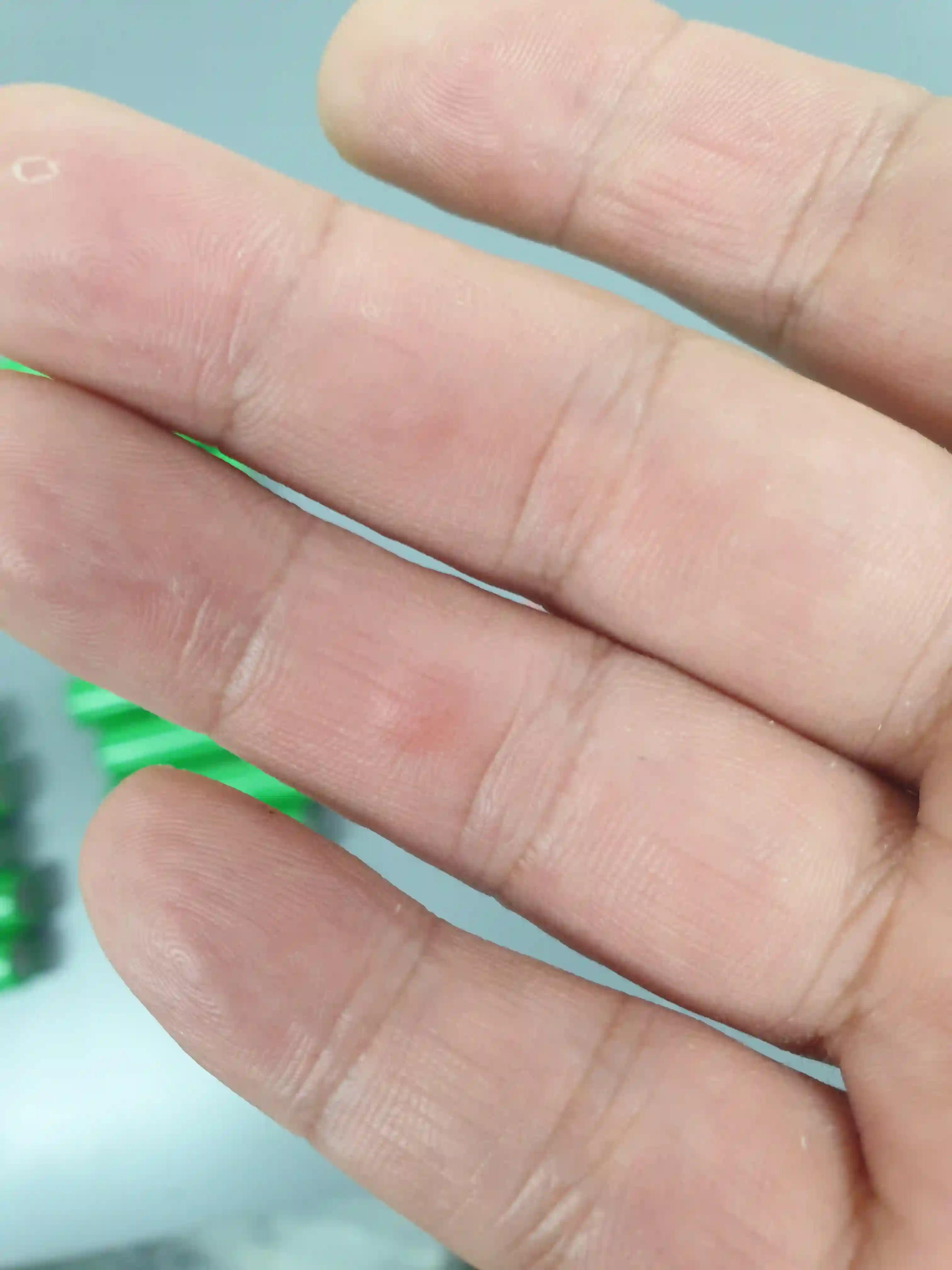 배터리 셀 분리 후 생긴 손가락 물집