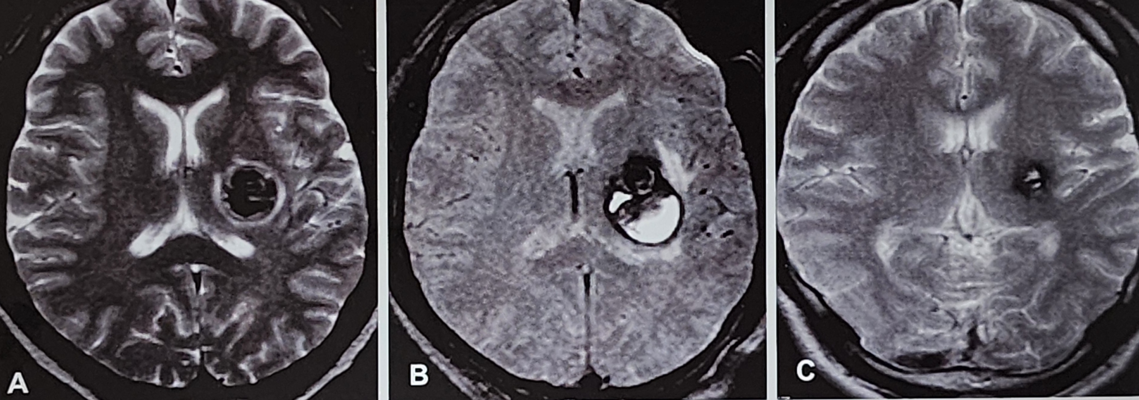 해면상 혈관종에 대한 방사선수술