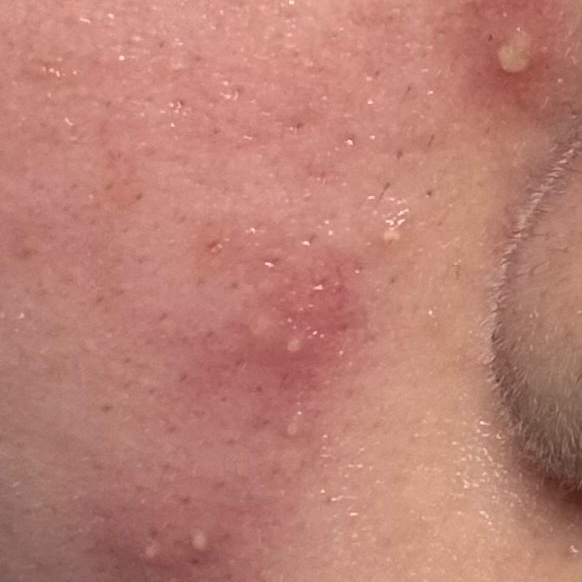 모낭염 피부 사진