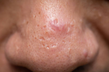 피지 과다 분비