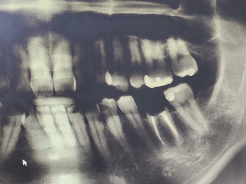 어금니-임플란트