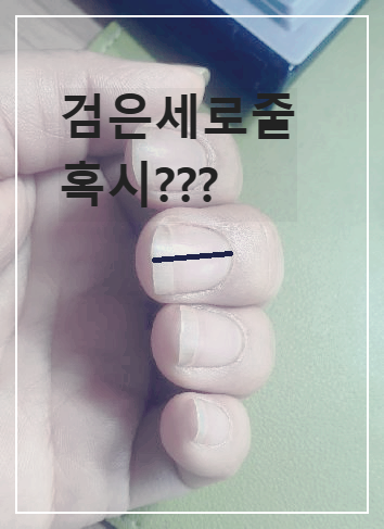검은세로줄이 있는 손톱
