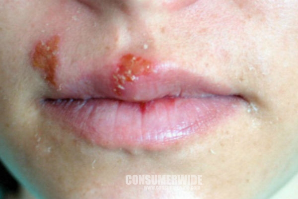 헤르페스 2형 바이러스 증상 