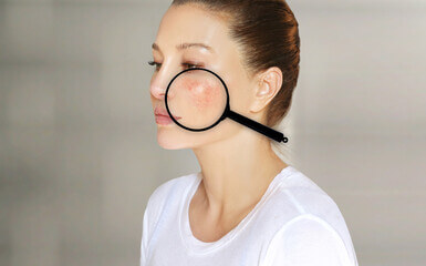 루프스 병 (systemic lupus erythematosus), 전신성 홍반성 원인과 증상에 대해 알아봤습니다. 매우 생소한 이름인데요. 얼굴에 나비 모양으로 발진이 일어났다면 한번쯤은 의심해봐야 합니다. 루프스 병은 어디 병원으로 가야 하는지와 치료방법까지 천천히 읽어 보시기 바랍니다.