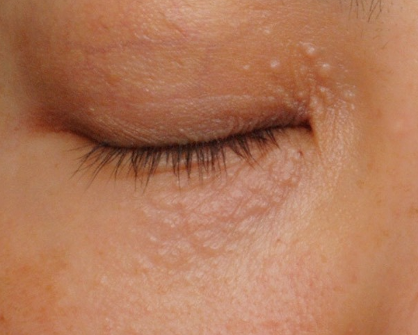 비립종 없애는 방법