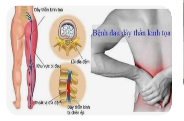 좌골신경통-증상