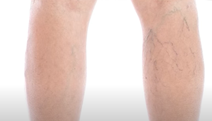 하지 정맥류 증상