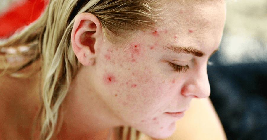 여드름이 나 있는 모습 - 2