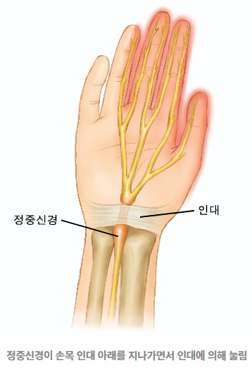 수근관증후군의 주요 원인