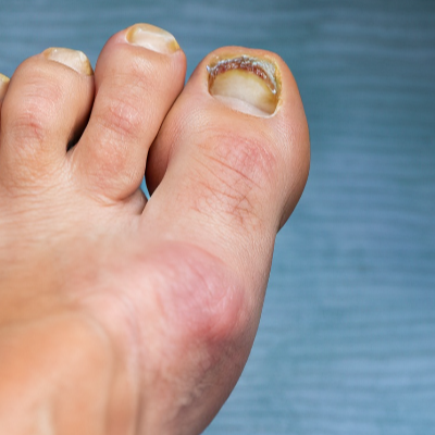 7. 무좀 없애는 법