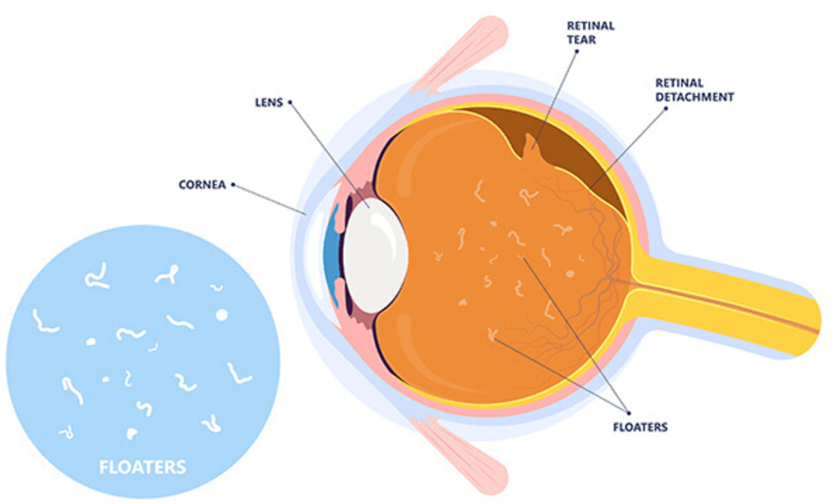 비문증 파인애플