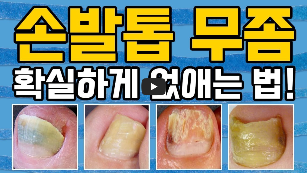 발톱 무좀