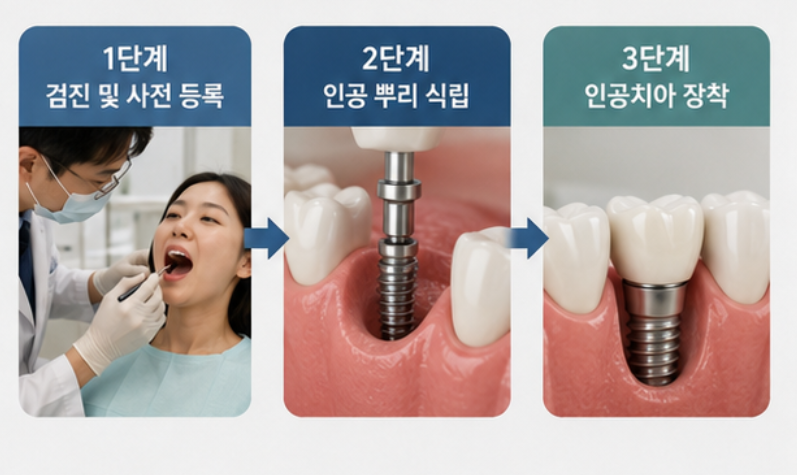 "65세 이상이면 임플란트 보험 적용돼요!" - 자격조건, 혜택, 신청방법 총정리 (2026)