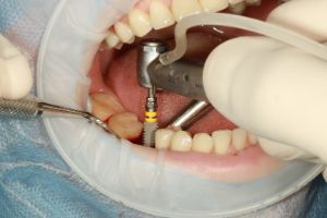 오산시-임플란트-치과-가격-비용-싼-곳,저렴한-곳,잘하는-곳,유명한-곳-BEST20-추천10