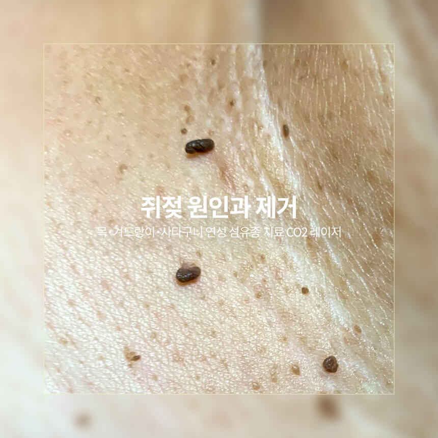 “쥐젖-원인과-제거-방법”