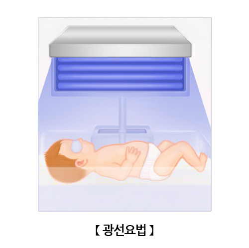 광선치료