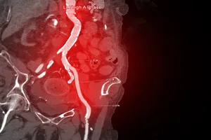 허혈성-심장질환