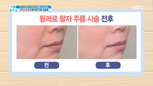 미간필러