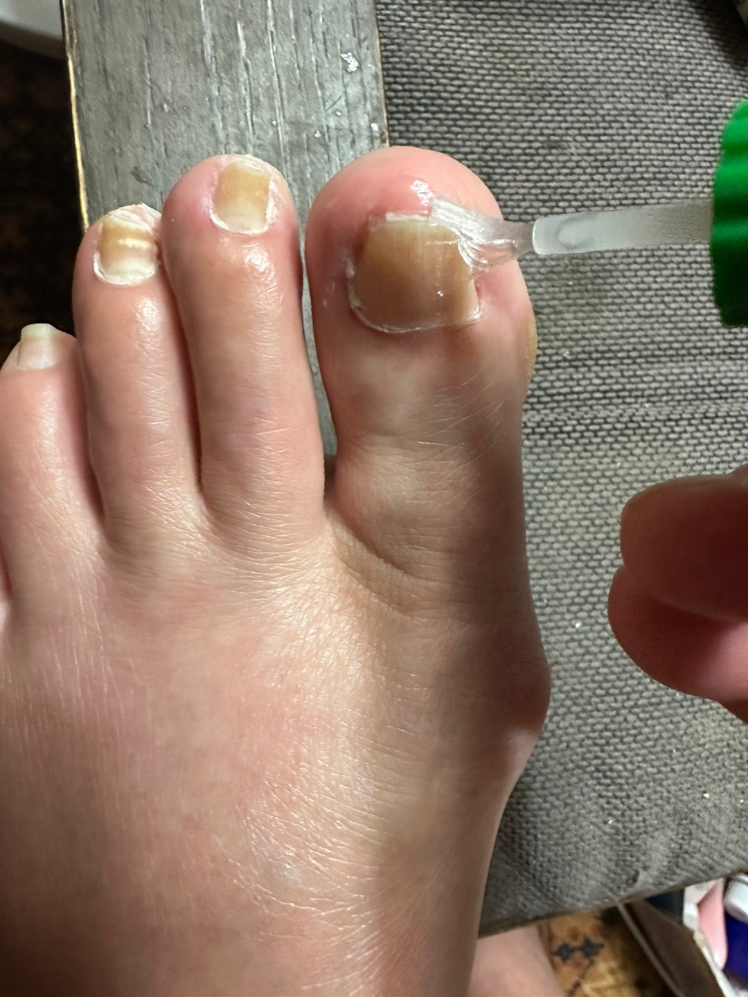 발톱 무좀, 왜 이렇게 잘 걸리고 안 낫는 걸까?