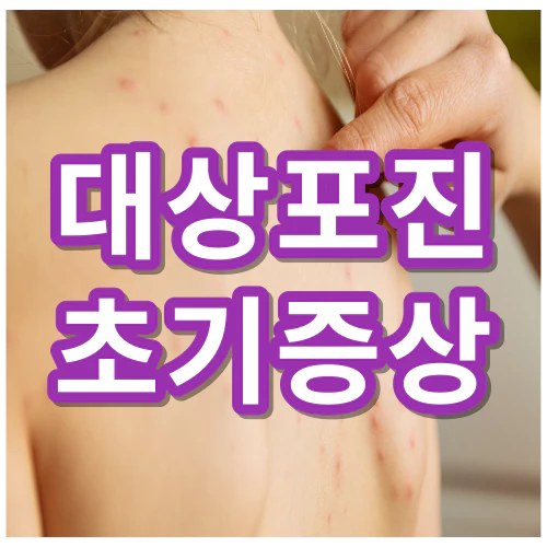 대상포진-초기증상-건강